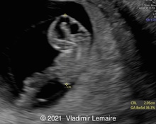 Normal appearance of Brain Vesicles: week by week image