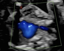 The Aberrant Right Subclavian Artery in Normal Fetuses image