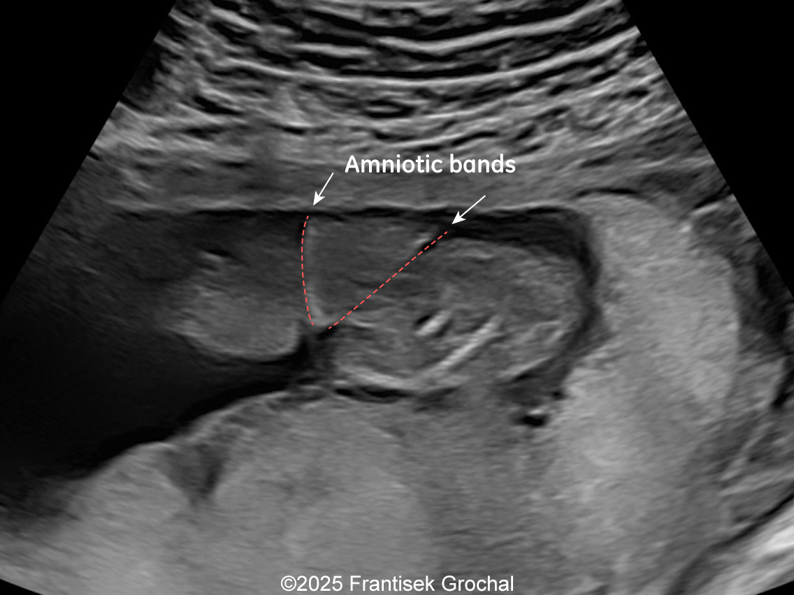 Constriction of fetal torso by two stripes of the amniotic bands