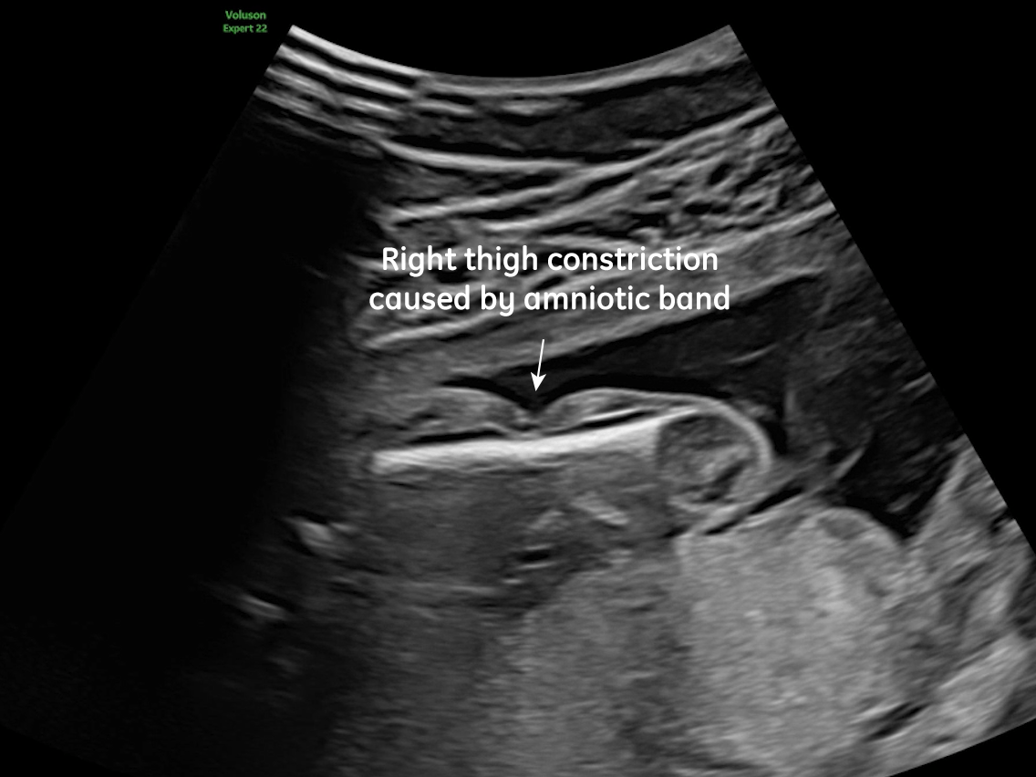 Constriction of the right thigh by the amniotic band