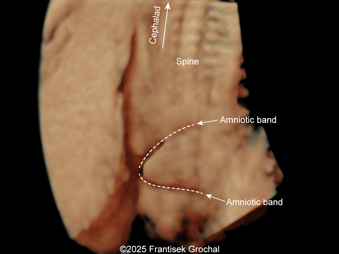 Constriction of fetal torso by two stripes of the amniotic bands