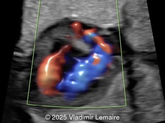 Four-chamber view with color Doppler.