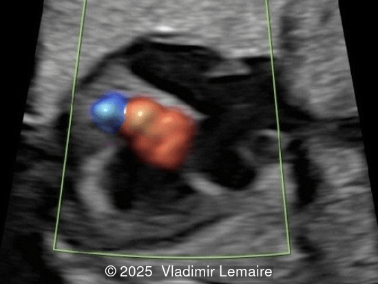 Four-chamber view with color Doppler.