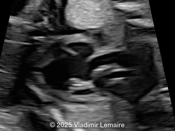 Left Ventricular outflow tract view.