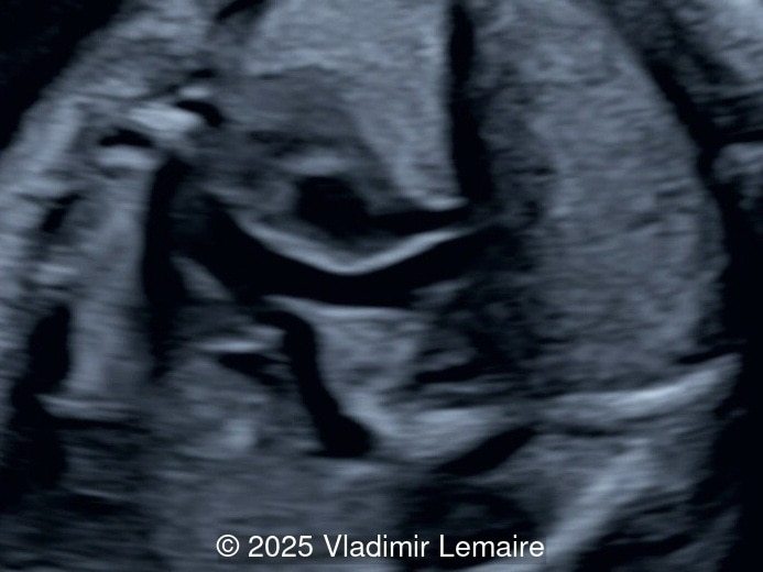 Right Ventricular outflow tract view.