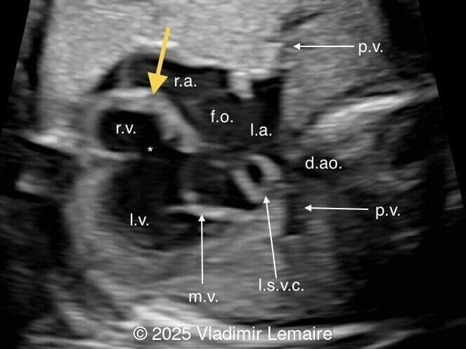 Basal four-chamber view. Note the presence of an atretic tricuspid valve (yellow arrow) as well as a ventricular septal defect (*). 