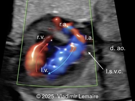 Four-chamber view with color Doppler. Color Doppler confirms the absence of blood flow across the tricuspid valve in diastole.