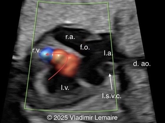 Four-chamber view with color Doppler. Blood enters the right ventricle across the VSD in late diastole and systole.