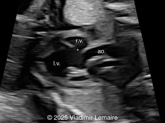 Left ventricular outflow tract view.