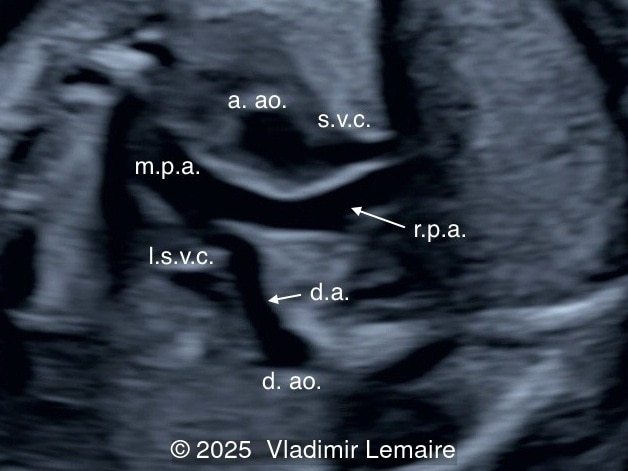 Right ventricular outflow tract view.