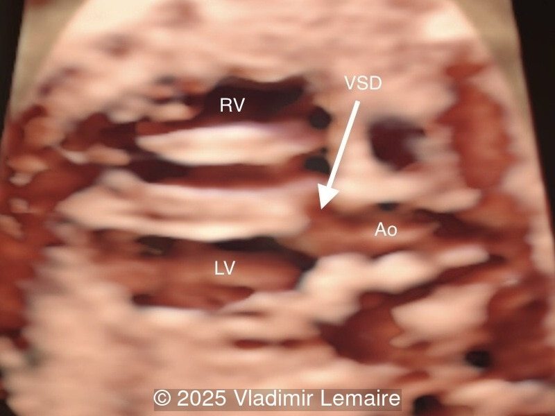 3D spatiotemporal image correlation (STIC) ultrasound volume at the level of the five-chamber view. Note the presence of a VSD and a dilated aorta.