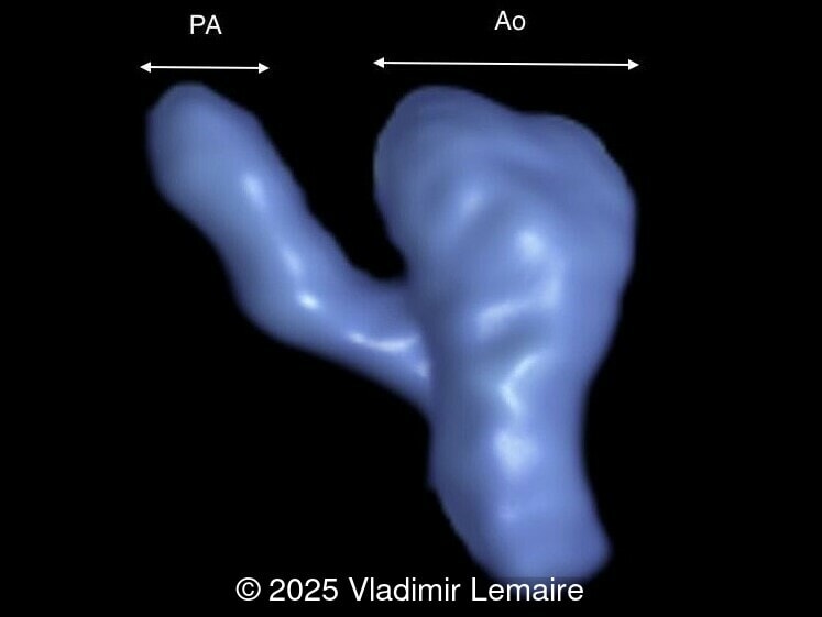 3D spatiotemporal image correlation (STIC) ultrasound volume displayed in glass-body mode at the level of the three-vessel-trachea view. Note the small size of the pulmonary artery as compared to the aorta with antegrade flow.