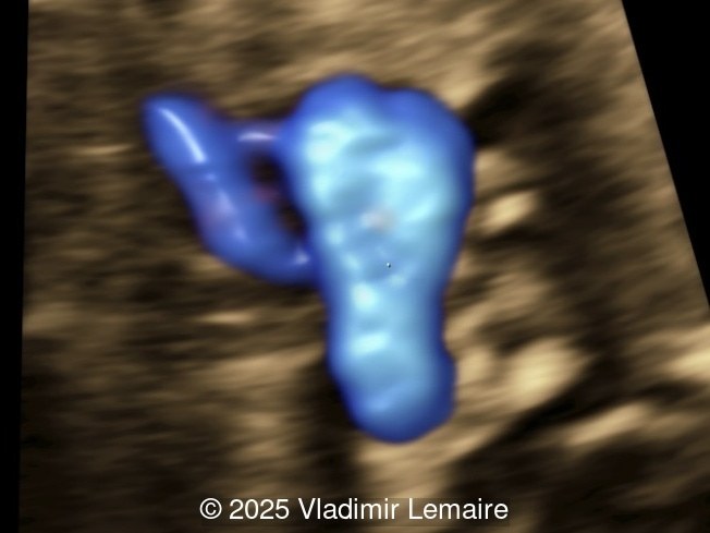 STIC of the three-vessel-trachea view with color Doppler coupled with volume contrast imaging (VCI-A).