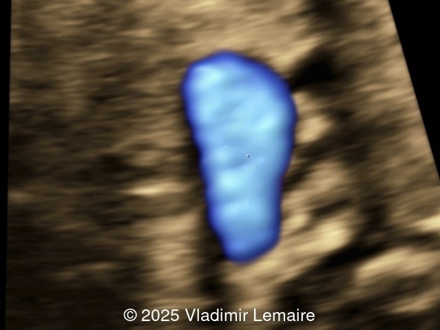 STIC of the transverse aortic arch view with color Doppler coupled with volume contrast imaging (VCI-A). Note the presence of the dilated aorta.