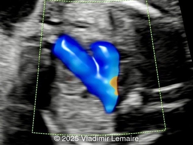Three-vessel-trachea view with color Doppler.