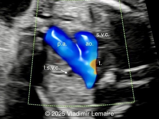 Three-vessel-trachea view with color Doppler.