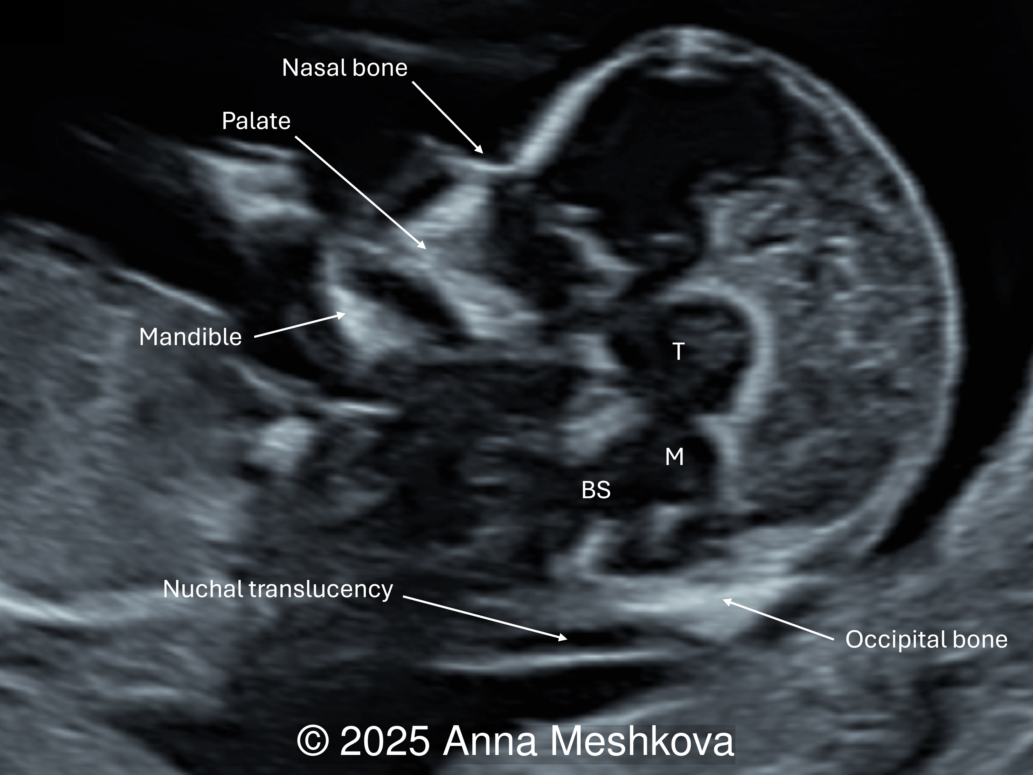 In a fetus with spina bifida, some fluid remains visible, however the normal landmarks of the IT are absent. The choroid plexus and future cisterna magna are not clearly seen. 