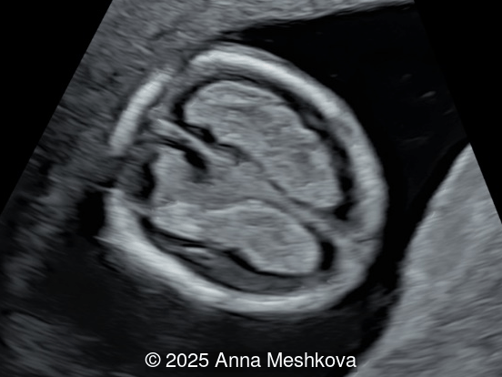 Dry brain sign is demonstrated in the axial view of the fetal head at 13 weeks gestation. Note the large and long choroid plexus in comparison to head size in a fetus with open spina bifida.