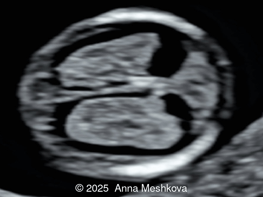 Normal appearance of the brain at 11-13 weeks