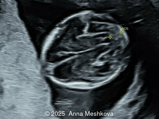 Normal oblique axial view of the brain shows thalami and cerebral peduncles separated by the aqueduct of Sylvius (AOS). A space separates the AOS and occipital bone. The transition between the cerebral peduncles and thalami forms an acute angle.