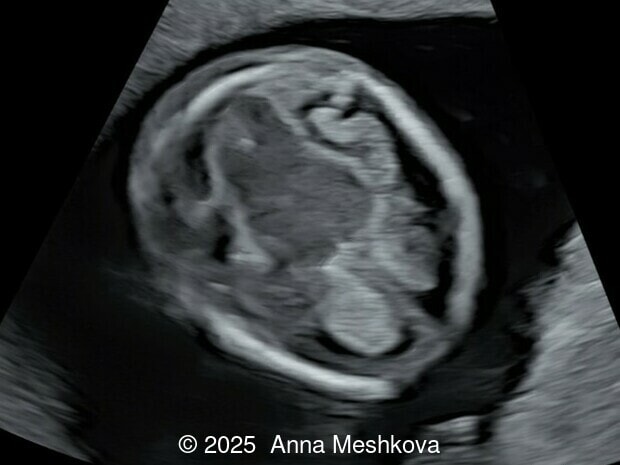 In spina bifida, the midbrain is posteriorly displaced, eliminating the space between the cerebral peduncles and the occipital bone. The transition between the cerebral peduncles and thalami appears as two parallel lines instead of the normal acute angle