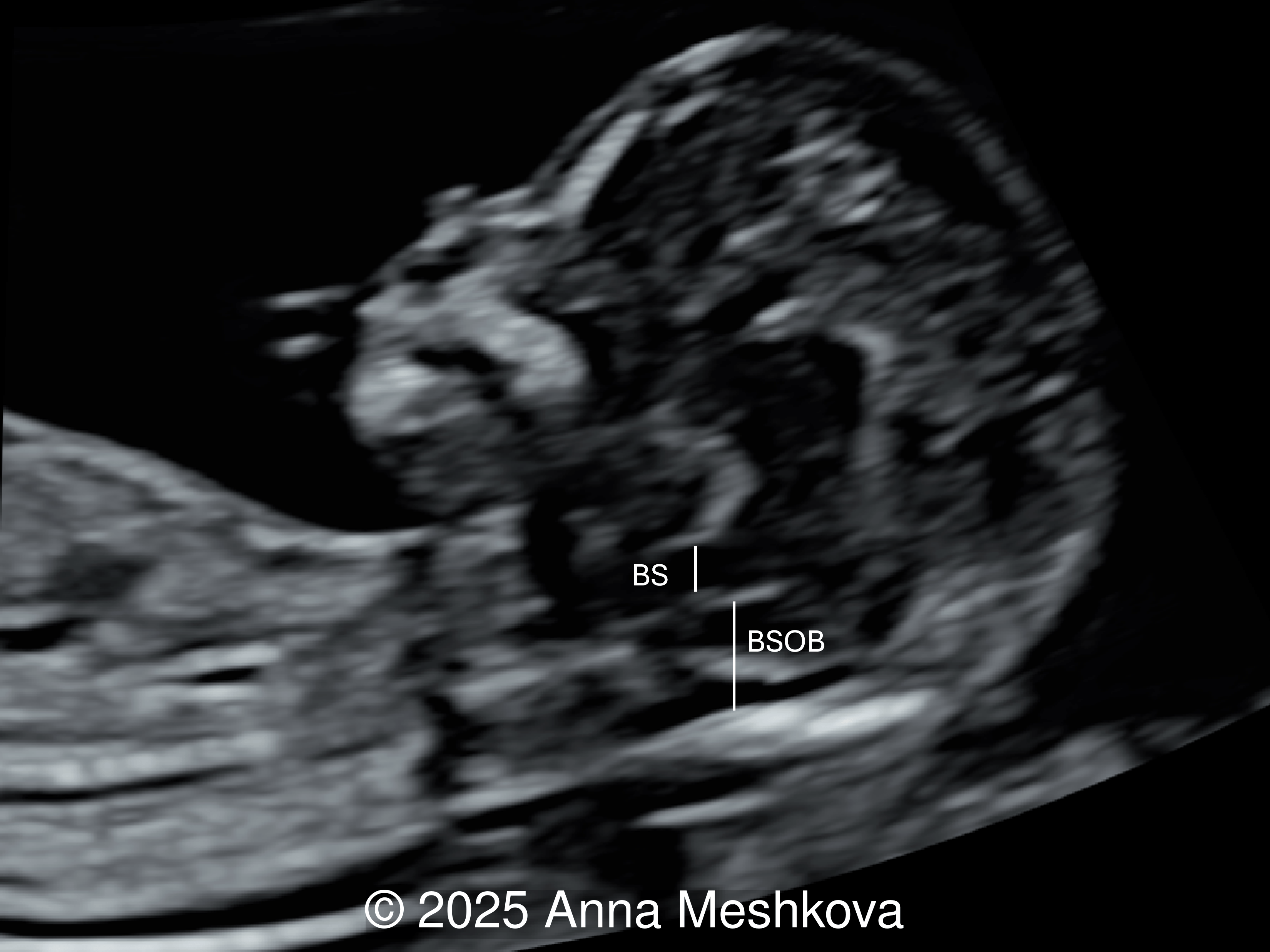 In a normal fetus, the brainstem (BS) is relatively narrow and shorter in length than the brainstem–occipital bone (BSOB) distance. 