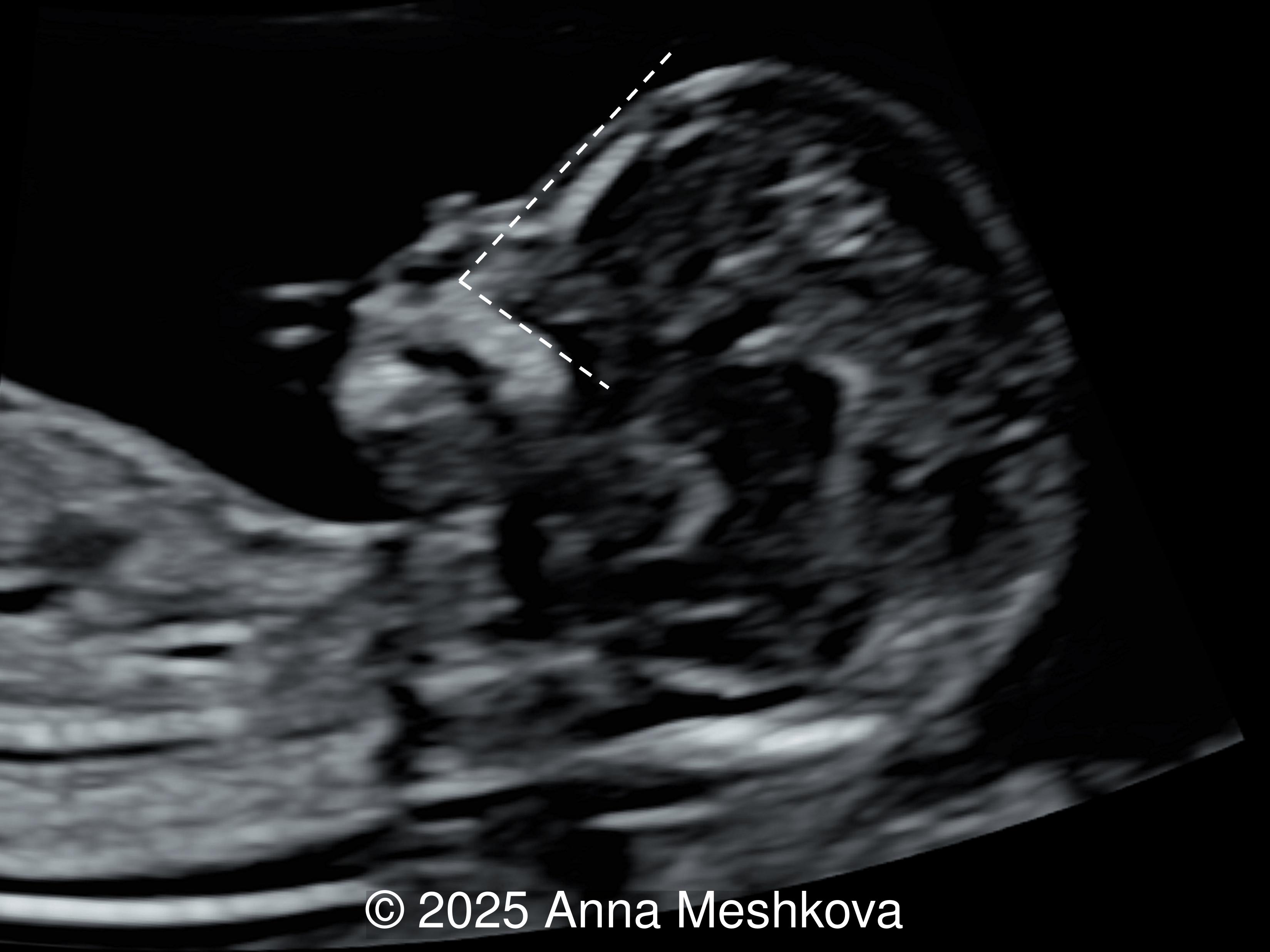 Frontomaxillary facial angle in a normal fetus at 13 weeks' gestation.
