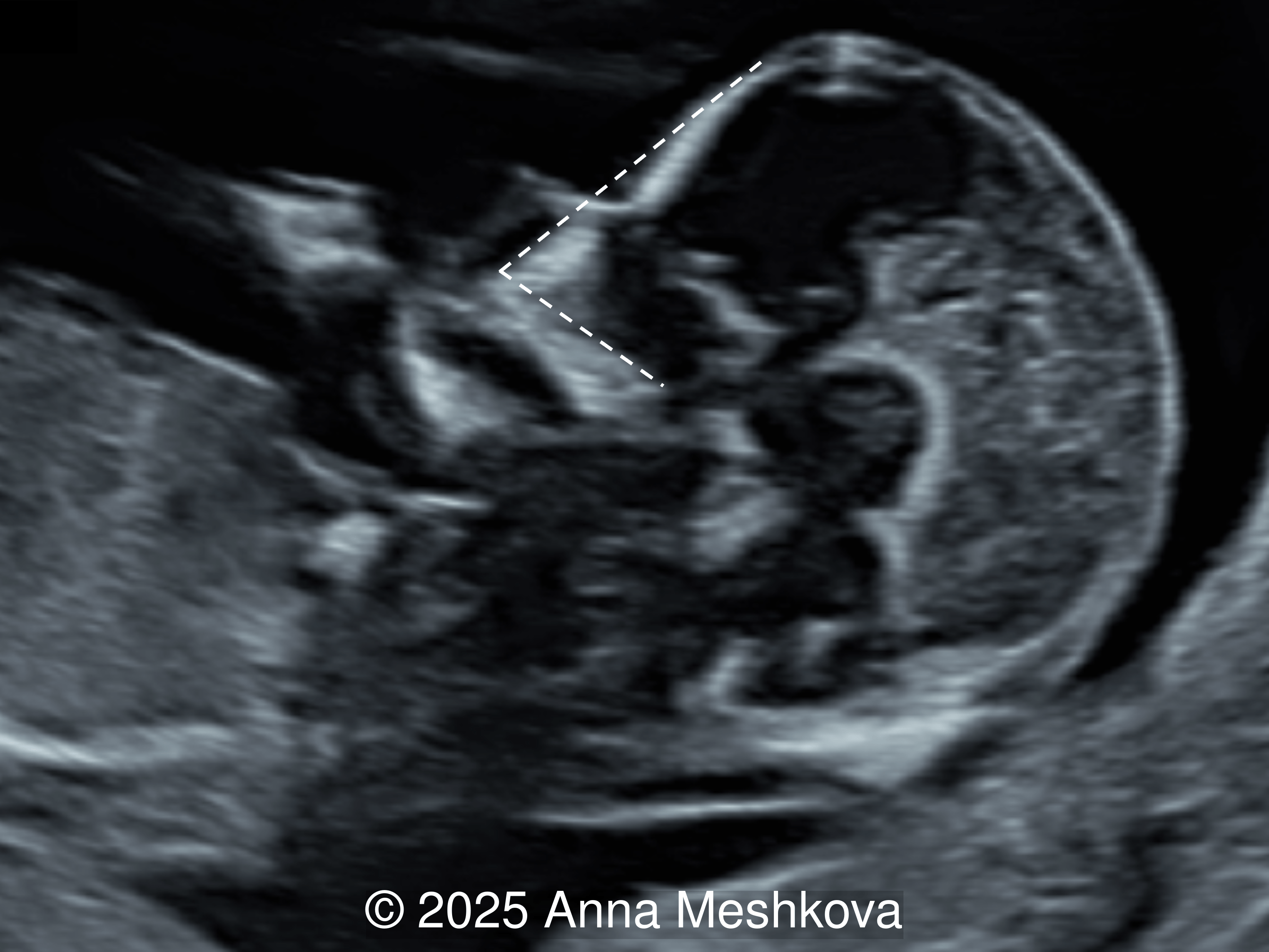 A fetus with spina bifida shows a narrower frontomaxillary facial angle.