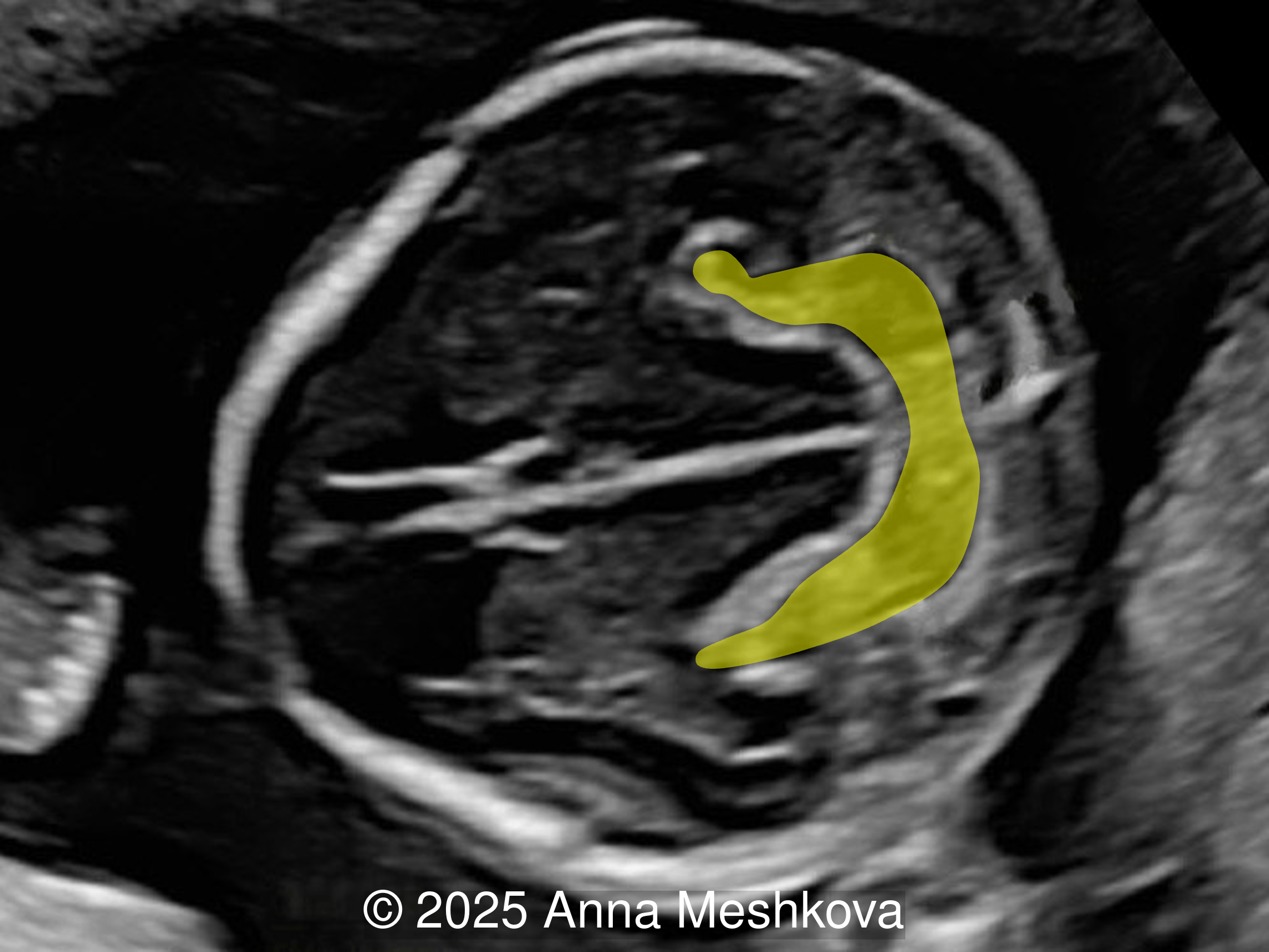 Image demonstrates the Lemon sign with scalloping of the frontal bones and the Banana sign with caudal displacement of the cerebellum (yellow shading).