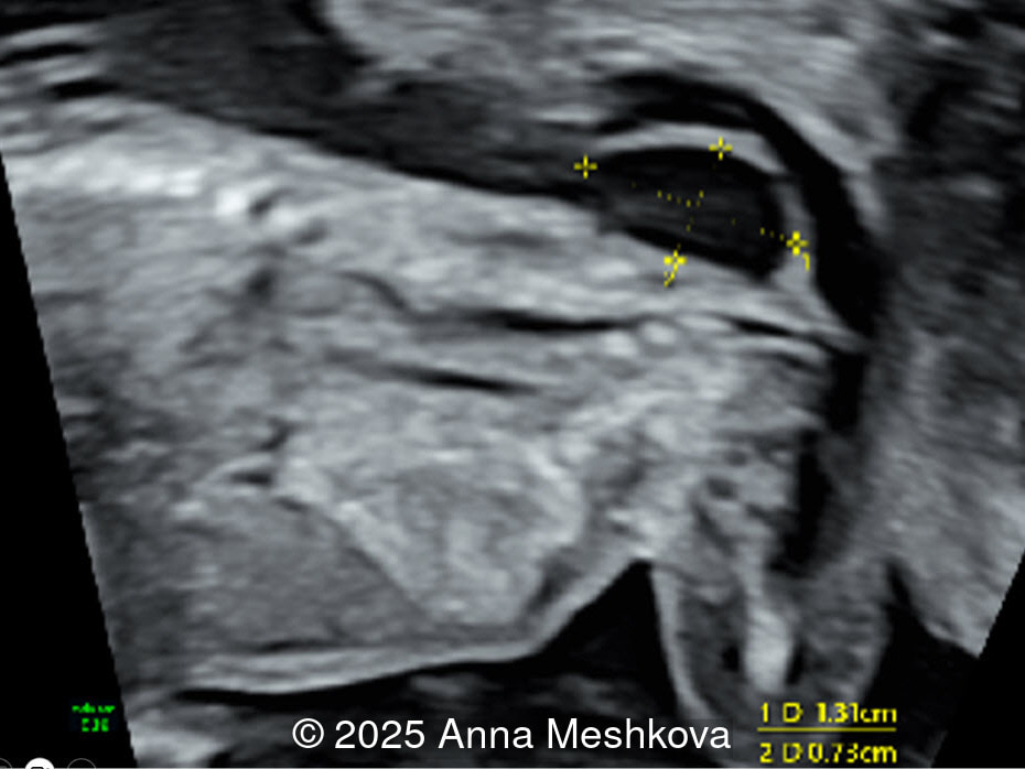 Direct spinal examination reveals cystic mass at the site of the lesion