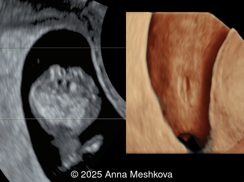3D reconstruction of the spinal defect in the lumbosacral region at 13 weeks gestation