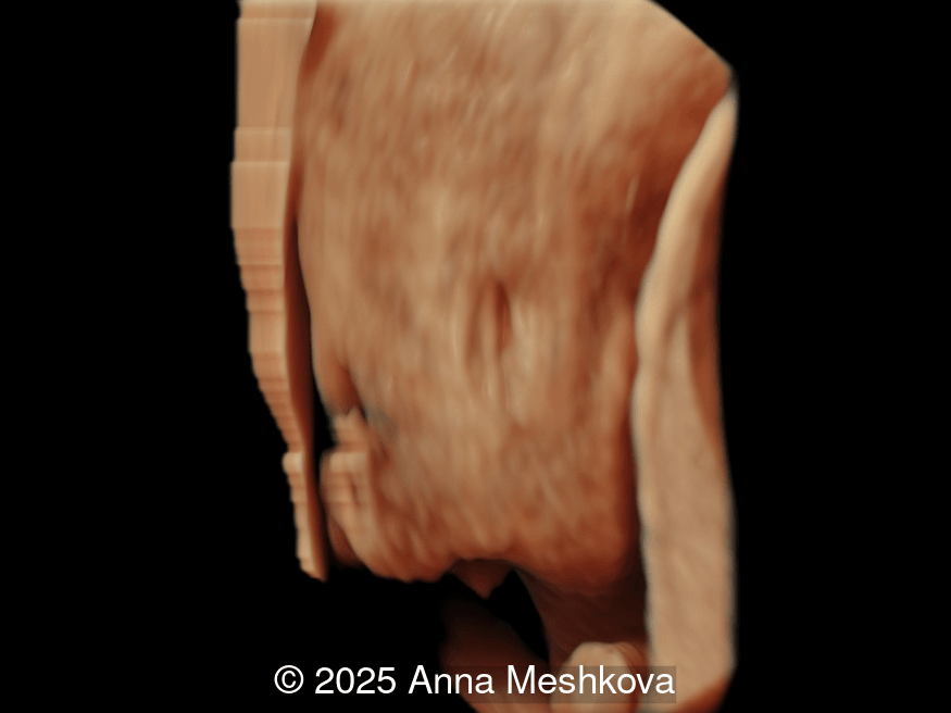 3D reconstruction of the spinal defect in the lumbosacral region at 13 weeks gestation