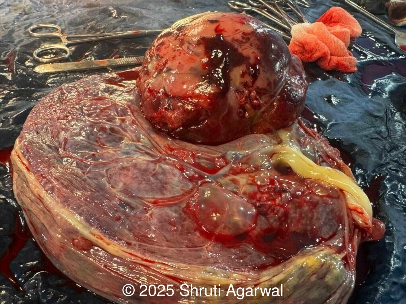 Postnatal image of the placental tumor