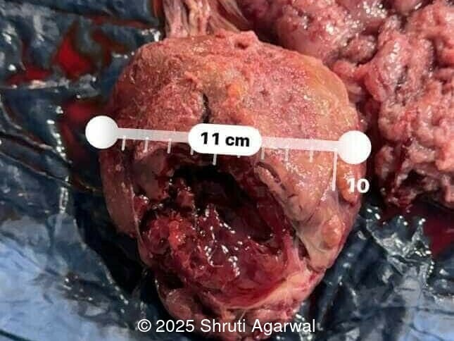 Postnatal image of the placental tumor
