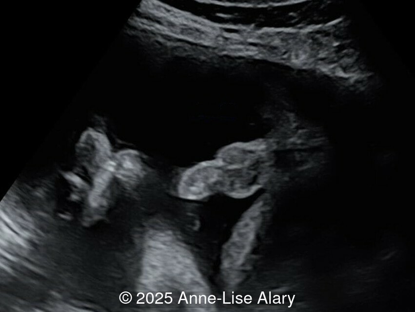 Axial image of the perineum