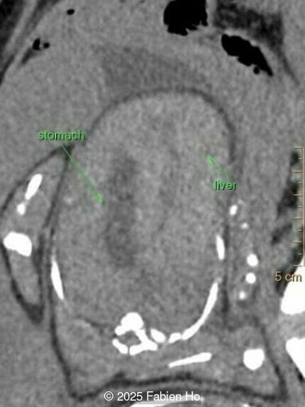 Axial image of the fetal abdomen