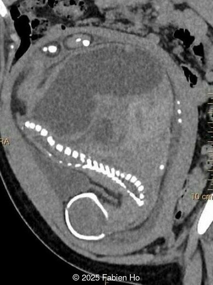 Sagittal image of the fetal thorax, abdomen, and pelvis