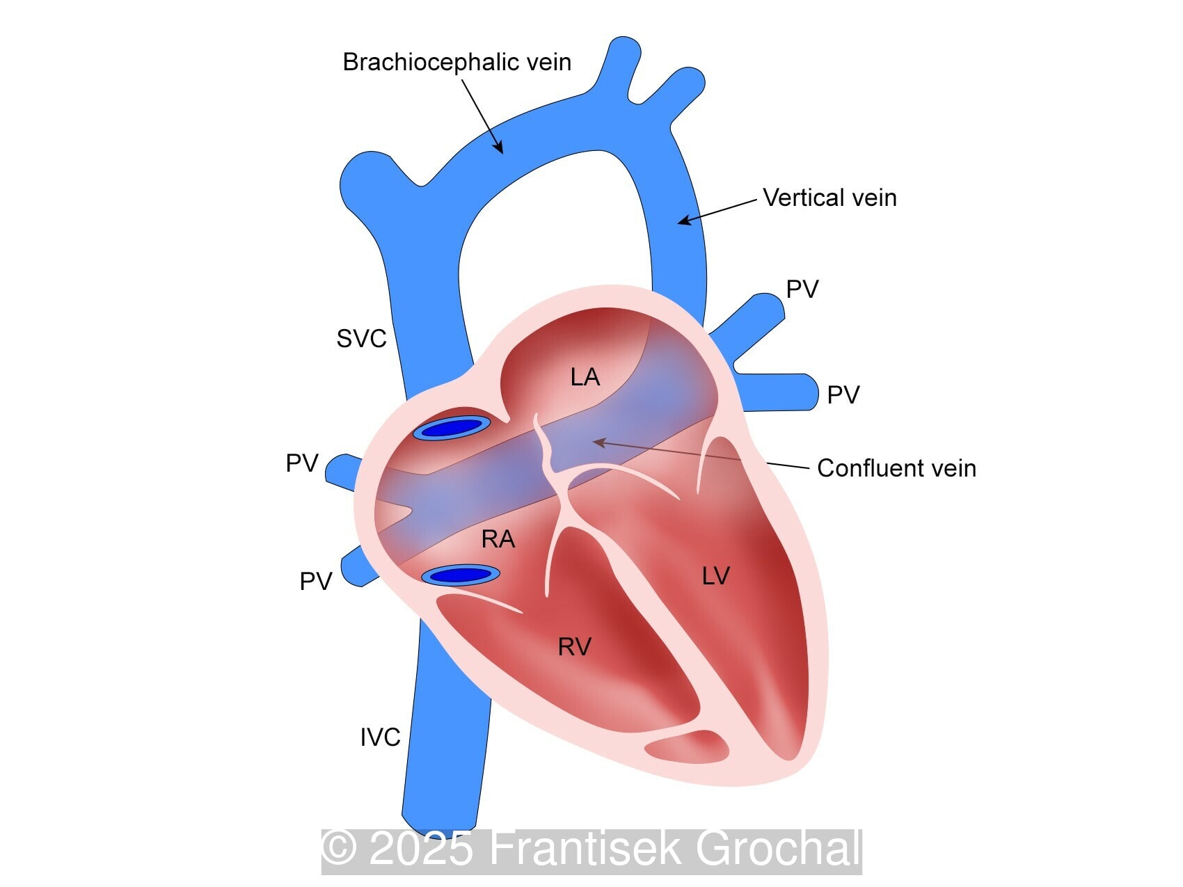 Diagram demonstrating total anomalous pulmonary venous return, Type I (Supracardiac)
