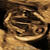 Prenatal diagnosis a case of 69, XXY with open spina bifida in the first trimester