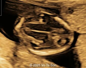 Prenatal diagnosis a case of 69, XXY with open spina bifida in the first trimester