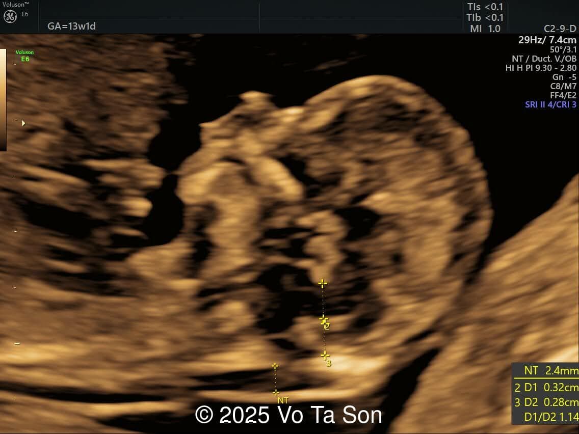 Mid-sagittal view of the brain