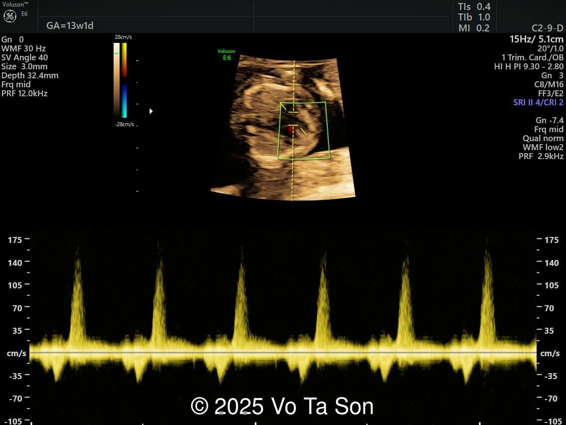 Tricuspid  flow