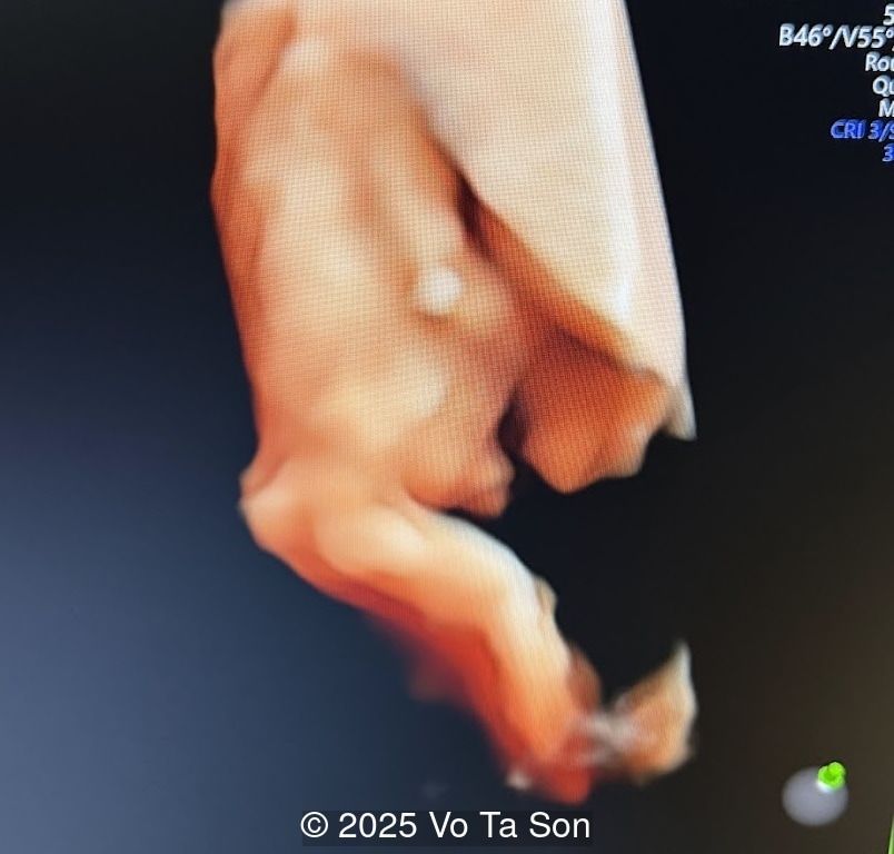 Spinal defect in the sacral region visualized on 3D ultrasound.