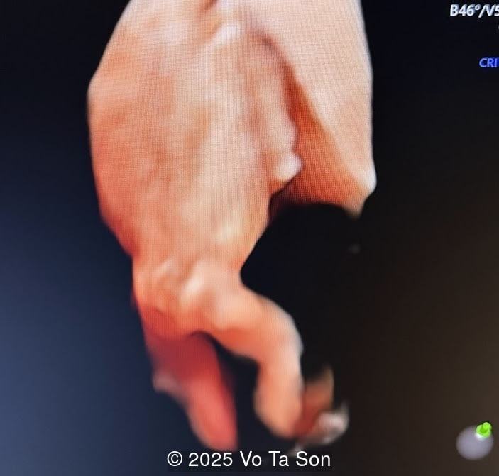 Spinal defect in the sacral region visualized on 3D ultrasound.